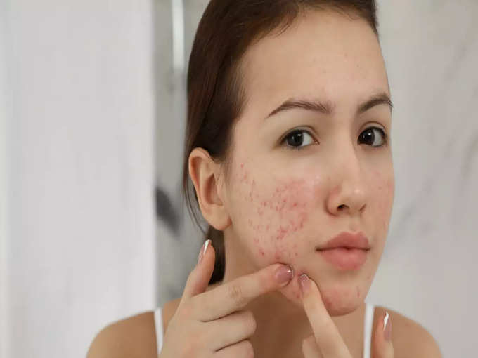 ​பரு உண்டாக்கும் சருமம் (acne prone skin)