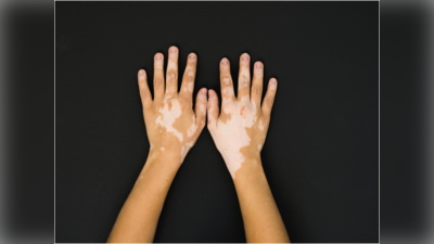 Vitiligo: ಕೆಲವರ ಚರ್ಮದಲ್ಲಿ ಈ ರೀತಿಯ ಬಿಳಿ ಪ್ಯಾಚ್‌ಗಳನ್ನು ನೋಡಿದ್ದೀರಾ? ಇದಕ್ಕೆ ಕಾರಣವೇನು ಗೊತ್ತಾ?