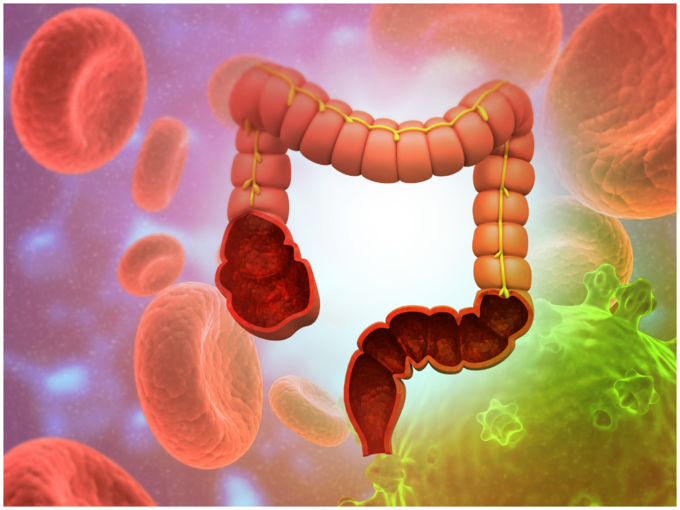 ಕರುಳಿನ ಕ್ಯಾನ್ಸರ್‌ನ್ನು ದೂರ ಮಾಡುತ್ತದೆ 
