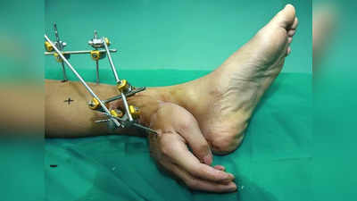 कभी सोचा है क्या होगा अगर कटे हुए हाथ को पैर से जोड़ दिया जाए? चीन के डॉक्टर ने किया था कमाल