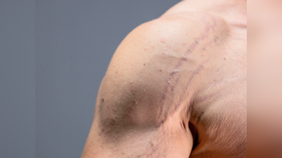 Men Skin Care: महिलाओं की तरह पुरूषों में भी पड़ते हैं स्‍ट्रेच मार्क के निशान, पेट-कमर और बाजू से ऐसे करें गायब
