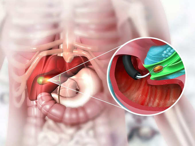 ​பித்தப்பை கற்கள் இருந்தால் உணவுக்கு பிறகு வயிற்று வலி வருமா?​