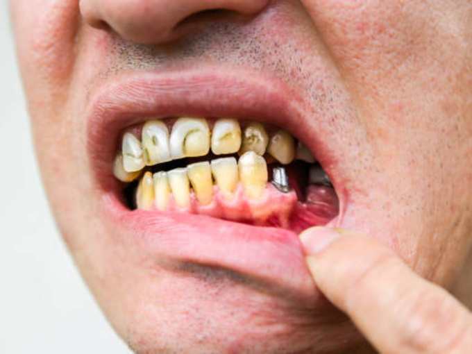 दात पडण्यापासून कसे वाचवाल