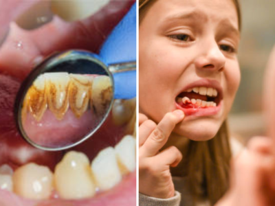 Tooth Decay : दातांच्या दुखण्याला करा बाय बाय... या जीवनसत्वाच्या कमतरतेमुळे दात होतात खराब