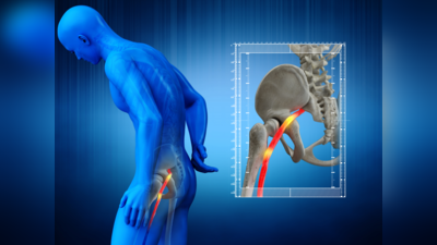 Sciatic Nerve: ಸೊಂಟದ ಕೆಳಗಿನಿಂದ ಕಾಲಿನವರೆಗಿನ ಈ ನರದ ನೋವಿಗೆ ಚಿಕಿತ್ಸೆ ಏನು ಗೊತ್ತಾ?