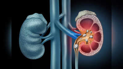 kidney stones: ఈ 5 పదార్థాలు.. కిడ్నీలో రాళ్లను సులభంగా కరిగిస్తాయి..!