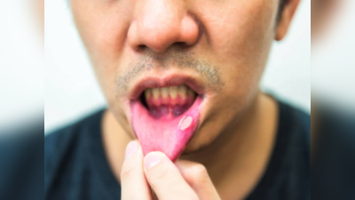 Mouth Ulcer: तोंडाची चव जातेय? असह्य वेदना अन् जळजळ होतेय मग तातडीने करा हे घरगुती उपाय