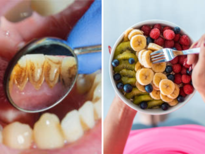 Teeth Whitening : औषधं, टूथपेस्ट सोडा..4 फळांनी दातांवरचा पिवळा थर आणि काळ्या हिरड्या स्वच्छ करा, नैसर्गिक उपाय