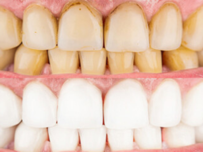 दातांचा पिवळसरपणा त्वरीत घालवून मोत्यांसारखे चमकविण्यासाठी वापरा नारळ तेल आणि हळदीचे मिश्रण