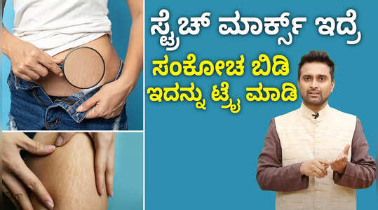 ಸ್ಟ್ರೆಚ್ ಮಾರ್ಕ್ ಇದ್ರೆ ಚಿಂತೆ ಬೇಡ, ಮನೆಮದ್ದು ಬಳಸಿ