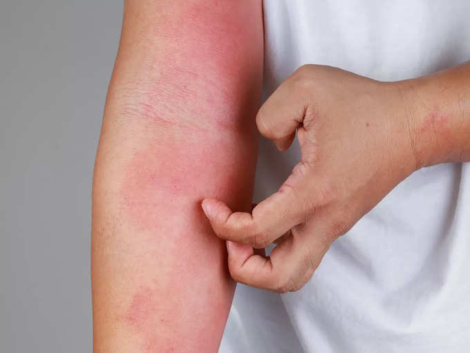 5.  Allergic rash