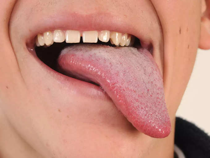 wounds on tongue