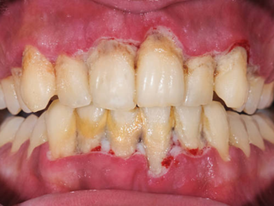 पिवळ्या दातांसाठी वापरा बेकिंग सोडा, हिऱ्यापेक्षाही चमकतील दात जाणून घ्या घरगुती उपाय