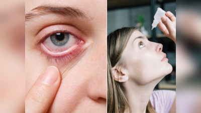 Eye Flu Home Remedies: આઇ ફ્લૂથી લાલ થઇ ગયેલી આંખો - બળતરાં, લાલાશમાં તત્કાળ રાહત આપશે 5 ઘરેલુ નુસખા