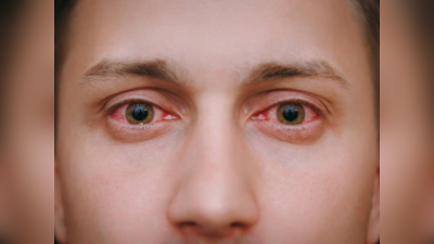 Eye Flu वर ७ आयुर्वेदिक उपाय ठरतील गुणकारी, डोळ्याची सूज-खुपणं यावर मिळेल आराम