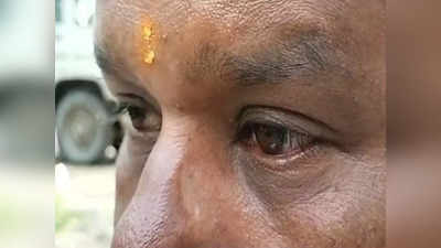 Indore News Today Live: आंखों में चुभन और जलन, लाल होना, कहीं आपको भी तो नहीं है आई फ्लू, जाने लक्षण और बचाव के तरीके