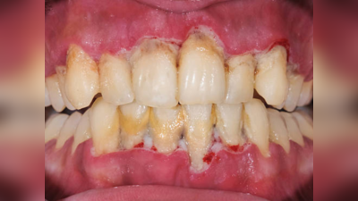 अनेकवेळा घासूनही दातांवरील लाल पिवळे डाग जात नाहीत? मग मोत्यासारख्या चमकदार दातांसाठी करा हे उपाय