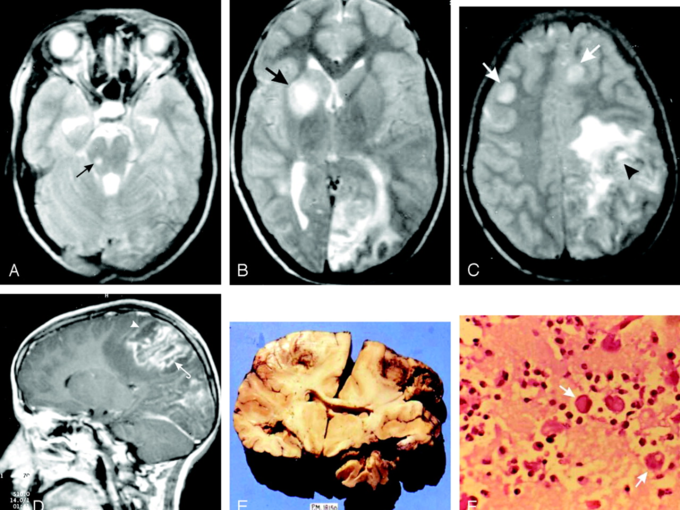 Brain-Eating Amoeba