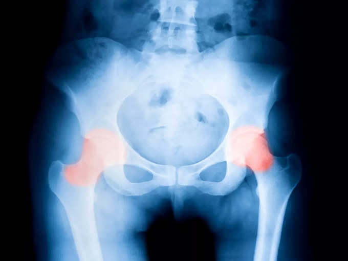 hip fracture