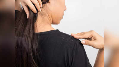 How to get rid of dandruff in monsoon: వర్షాకాలం చుండ్రు సమస్యకు చెక్‌ పెట్టేయండిలా..! 