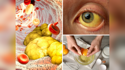 खून में Bad Cholesterol भरने से आंखों में दिखते हैं 4 लक्षण, नसों से गंदा कोलेस्ट्रॉल साफ कर देंगी ये 8 चीजें