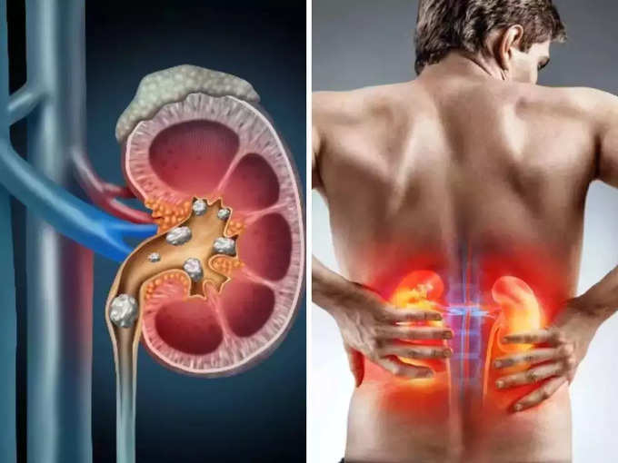 किडनी की पथरी के लक्षण (Symptoms Of Kidney Stones)