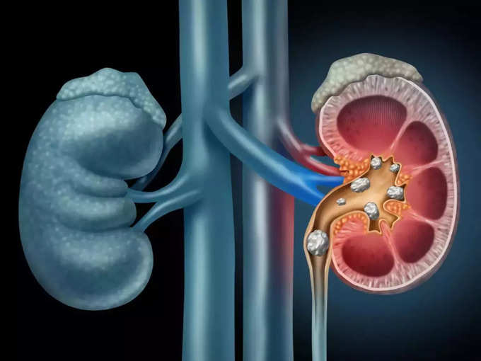 किडनी की पथरी के कारण (Causes Of Kidney Stones)