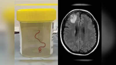 सापांमध्ये आढळणारा किडा महिलेच्या मेंदूत जिवंत सापडला; डॉक्टर चकित, जगातील पहिली घटना