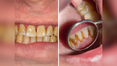 घरगुती उपायांनी दातांवरील पिवळा किळसवाणा थर करा झटक्यात कमी, 2-3 मिनिटांत तुमचे दात मोत्यासारखे चमकतील