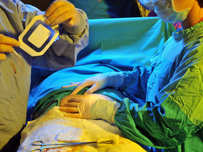 ​VSG शस्त्रक्रिया कशी काम करते?