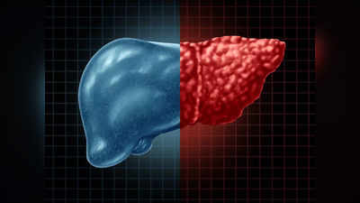 Non-alcoholic fatty liver disease:NAFLDలో లివర్‌ ఆరోగ్యంగా ఉండాలంటే.. ఈ ఆహారం కచ్చితంగా తీసుకోవాలి..!