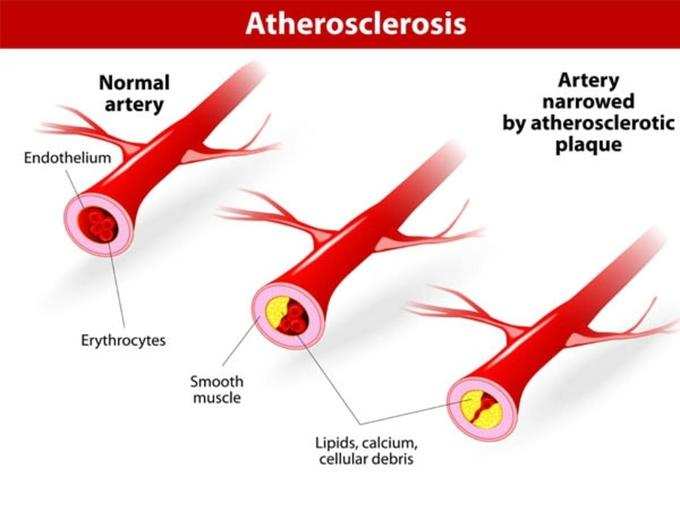 ​இதய தமனி நோய்கள் (Peripheral Artery Disease (PAD)) 