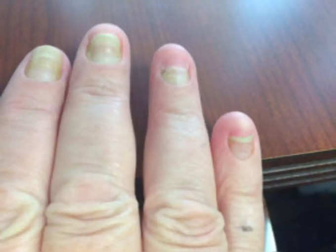 ​yellow nail syndrome 