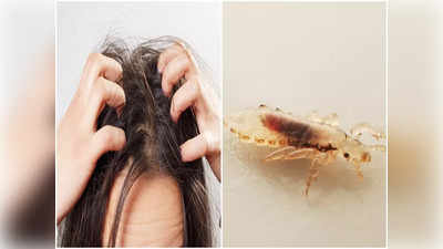 Lice Remedies: মাথা ভর্তি উকুনের জ্বালায় অস্থির, সারাক্ষণ স্ক্যাল্প চুলকায়? এই ৩ ঘরোয়া টোটকাতেই মিলবে সুরাহা