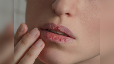 Cracked Lips: बार-बार फटते हैं होंठ तो पक्का है इन 5 में से 1 बीमारी, सारे काम छोड़ भागें डॉक्टर पास