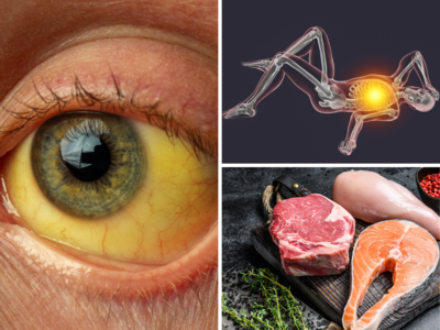 आंख में दिख जाता है Vitamin B12 की कमी का ये घातक लक्षण, अगर न खाई ये 10 चीजें तो लटक जाएगा