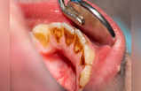 How To Remove Tartar From Teeth: जिद्दी Tartar को उखाड़ फेंकेंगे 6 देसी उपाय, झट से सफेद बनेंगे पीले दांत