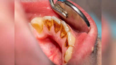How To Remove Tartar From Teeth: जिद्दी Tartar को उखाड़ फेंकेंगे 6 देसी उपाय, झट से सफेद बनेंगे पीले दांत