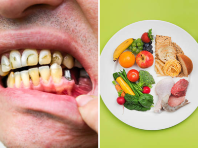 दात आणि हिरड्यांना निरोगी ठेवतात हे पदार्थ, दातांसाठी संतुलित डाएट