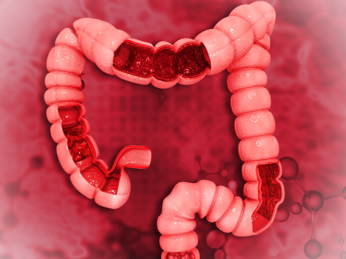 colorectal cancer intestine