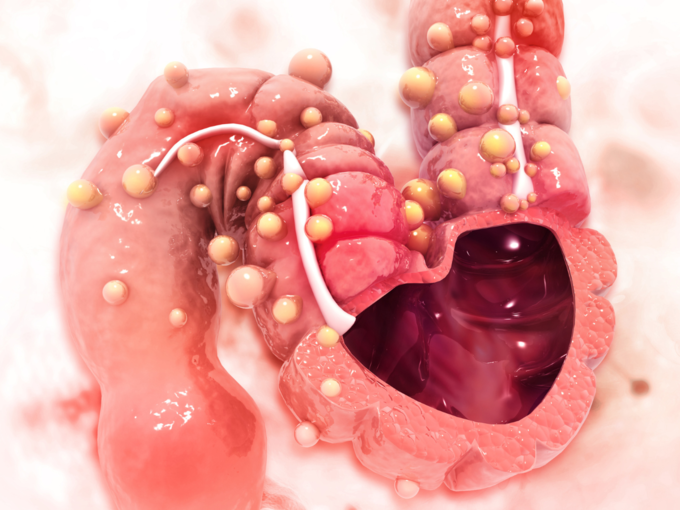 colon cancer intestine