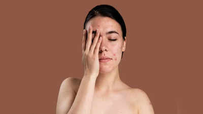 Skin Problems:అమ్మాయిలను ఎక్కువగా ఇబ్బంది పెట్టే.. 7  సౌందర్య సమస్యలు ఇవే..!