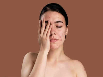 Skin Problems:అమ్మాయిలను ఎక్కువగా ఇబ్బంది పెట్టే.. 7  సౌందర్య సమస్యలు ఇవే..!