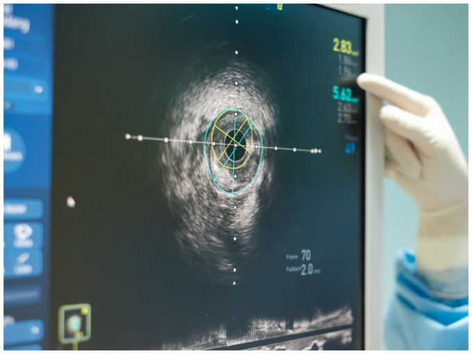 Coronary Artery Calcium Scan