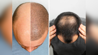 Hair Transplantationनंतर केसांची घ्या अशी काळजी, नाहीतर टक्कल पाठ सोडणार नाही