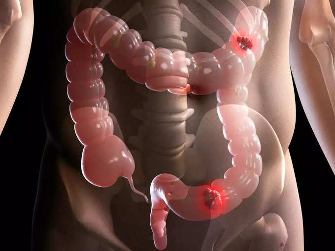 ​குடல் புற்றுநோய் ஆபத்து (colon cancer)