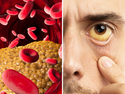 मुंह पर दिख रहे 4 लक्षण चीख-चीखकर बताते हैं खून में बढ़ गया Cholesterol, 4 तरीकों से कम करें कोलेस्ट्रॉल