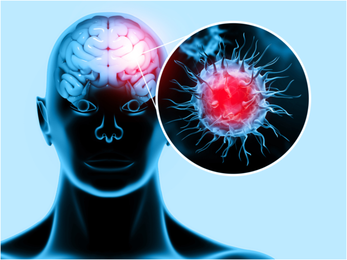 Chronic meningitis Chronic meningitis