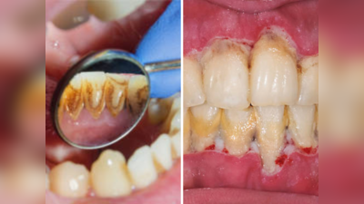 दातावरचा पिवळा थर एका वॉशमध्ये गायब, फक्त वापरा हे उपाय अंधारातही चमकू लागतील दात
