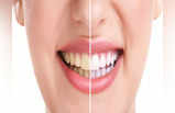 Yellow Teeth: এই ৪ টোটকার গুণে ঝকঝকে সাদা দাঁত পাবেন আপনি, হলুদ ভাবও উধাও হবে